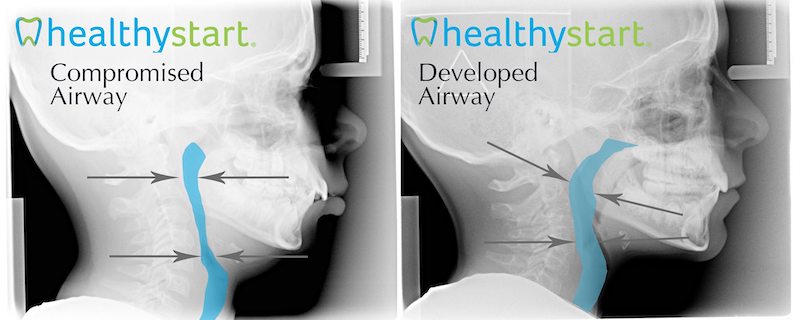 Compromised Airway Photo